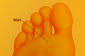 Plantar Warts